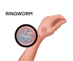 Ring worm